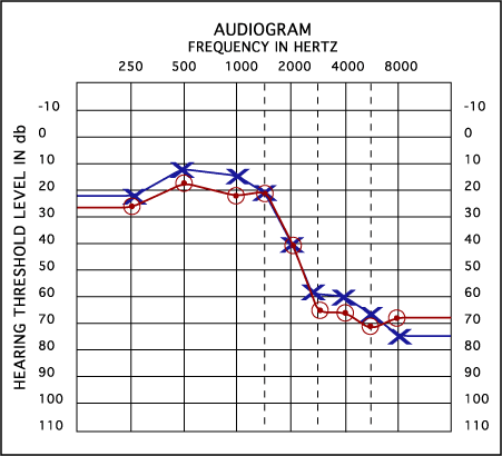 audiogram-example